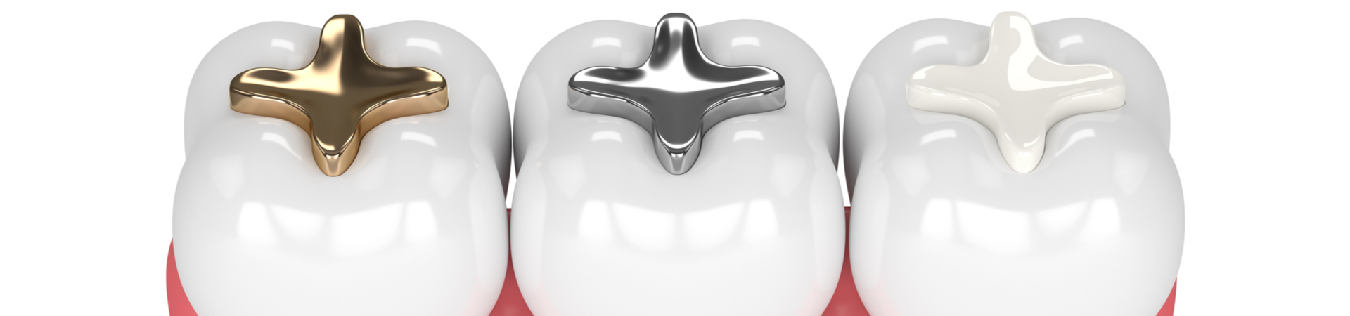 3 teeth with gold silver and white fillings